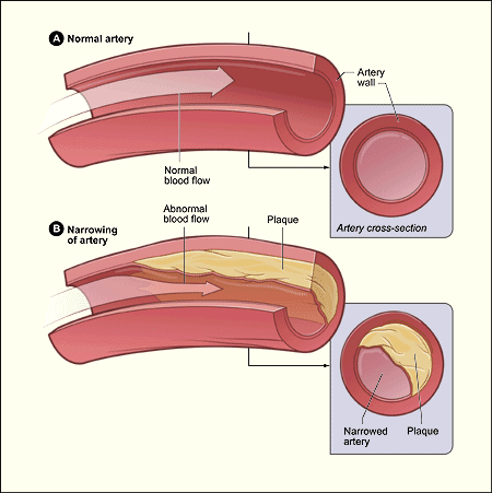 Atherosclerosis: building up of plaque on the artery wall, narrowing the artery