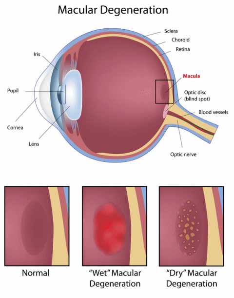 What is macular degeneration